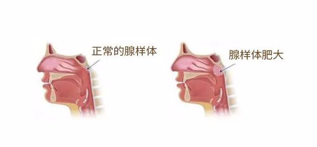 蕲艾穴位灸治——扁桃体炎